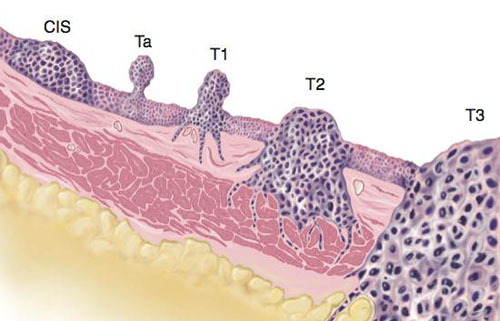 papilloma virus tumore vescica